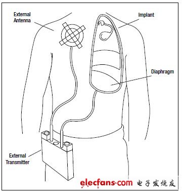 圖7,呼吸起搏器帶有用于膈神經(jīng)刺激的植入電極以及RF接收器，還有向植入體發(fā)射RF信號(hào)的外部天線(xiàn)，完成刺激起搏功能